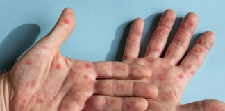 Dua Santri Ponpes di Meranti Ternyata Negatif Cacar Monyet